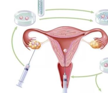 试管婴儿移植十七天稳定了吗？